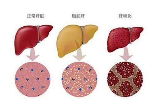 研究发现：干细胞疗法治疗肝硬化安全有效