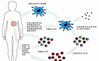 现代医学新支柱——什么是免疫细胞治疗（癌症患者的新希望）