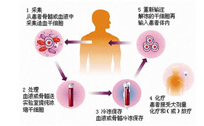 目前根治白血病最有效的方法——造血干细胞移植治疗！