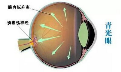 干细胞能改善青光眼吗？