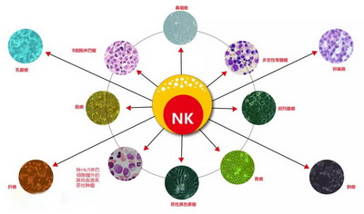 NK免疫细胞疗法多少钱一次？（NK免疫细胞疗法的优势）