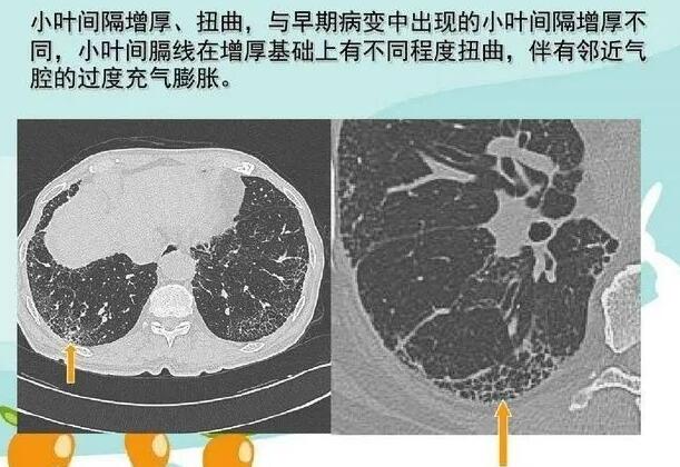 干细胞如何治疗肺纤维化？（肺纤维化的临床表现）