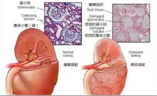 研究证明：干细胞有效改善肾功能挽救肾衰竭