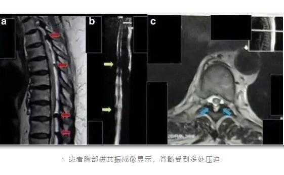 研究证明：干细胞有效改善肾功能挽救肾衰竭