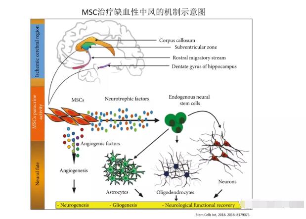 MSC间充质干细胞治疗缺血性中风的临床研究