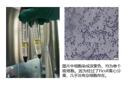 脐带血治疗支气管肺发育不良BPD新生儿的临床应用