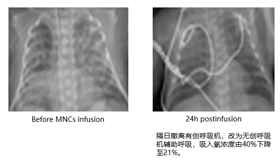 脐带血治疗支气管肺发育不良BPD新生儿的临床应用