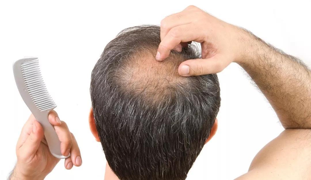 干细胞疗法解决脱发烦恼，促进毛发再生